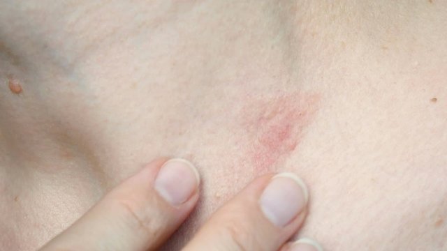 skin rash treatment on woman neck. Shingles, Disease, Herpes zoster, varicella-z, lichenoid dermatitis, pityriasis