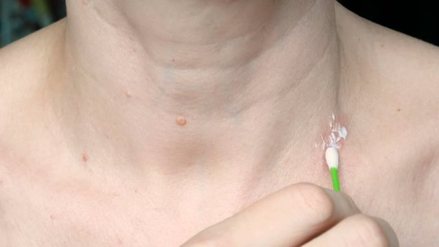 skin rash treatment on woman neck. Shingles, Disease, Herpes zoster, varicella-z, lichenoid dermatitis, pityriasis