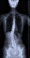 X-ray of whole spine with measurement tool in dark background. spine scoliosis.