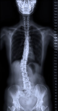 X-ray of whole spine with measurement tool in dark background. spine scoliosis.