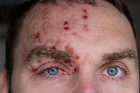 Man with Herpes Zoster (shingles) on the face, close up. Inflamed eyelid and red eye of a man suffering from herpes on the face. Purulent blisters on the face during Shingles
