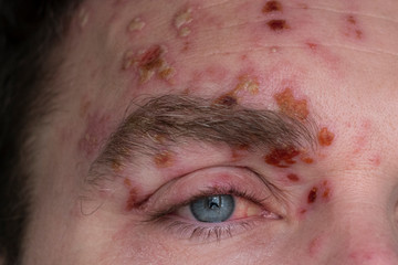 face of a man suffering from herpes zoster on the 7th day of illness. inflamed eyelid and eye and...