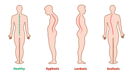 Diseases of the spine. Scoliosis, lordosis, kyphosis. Body posture defects. Back curvature. Spinal deformity types. Medical disease infographic. Diagnostic symptom. Vector illustration.
