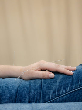 Acupuncture for hand injury