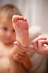 Little child's feet, burned from a flat grill