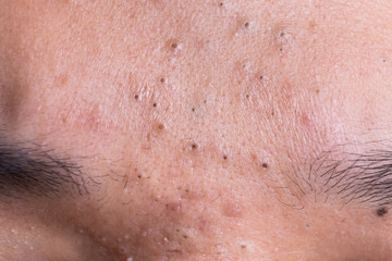 Fototapeta premium Ugly pimples blackheads on forehead of teenager
