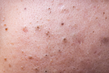 Fototapeta premium Ugly pimples blackheads on face of teenager