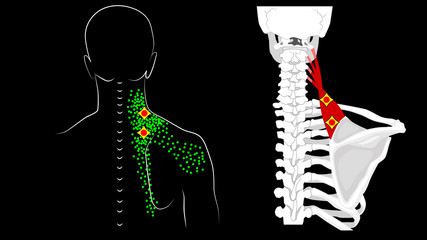 Levator scapulae muscle. Trigger points and muscle structure. Pain in the neck and shoulder blade.