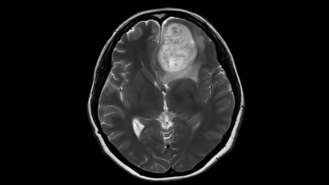 Magnetic resonance imaging (MRI) of brain, brain tumor