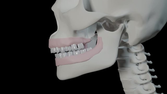 Malocclusion With Overbite