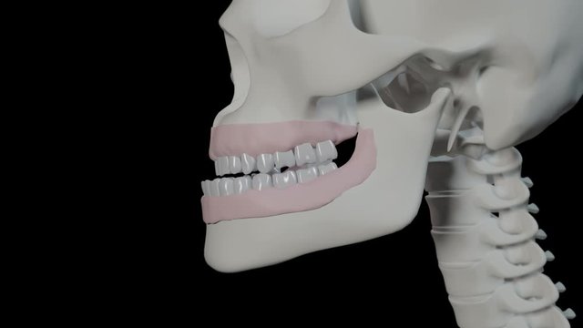 Malocclusion With Underbite
