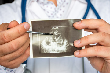 Heart ventricular dilation on ultrasound image concept photo. Doctor indicating by pointer on printed picture of ultrasound pathology of heart ventricular dilation. For diagnosis, radiology, cardiolog