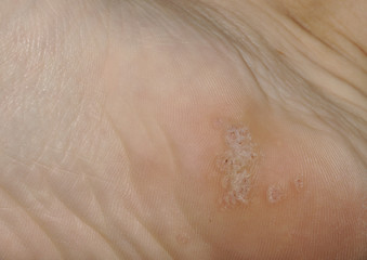 Close-up shot of a plantar wart on the bottom of a foot heel caused by the human papillomavirus, or HPV.