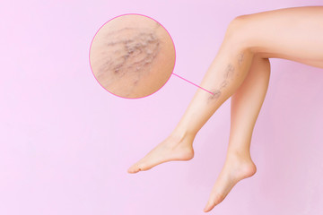 Female legs with varicose veins. Concept of human health and disease. Vascular diseases, problems of varicose veins. Enlarged image of blood vessels