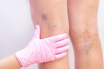 Female legs with varicose veins. At the doctors surgeons appointment. doctors hands in gloves....