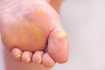 Warts and corns on a womans foot. dermatology disease. plantar warts. at the appointment with a dermatologist. female foot with warts on a light background.