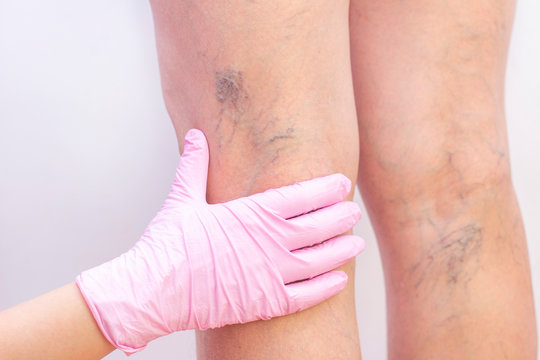 Varicose Veins on a Female Legs Stock Photo - Image of medical