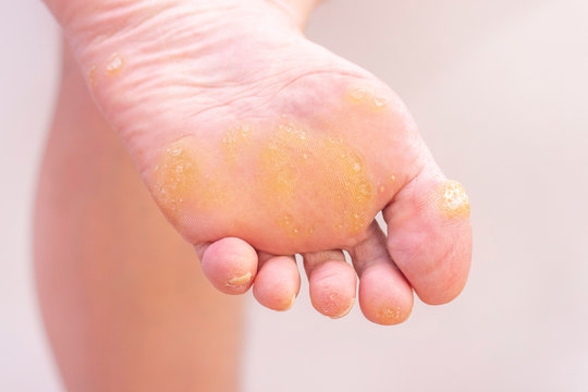 Warts and corns on a womans foot. dermatology disease. plantar warts. at the appointment with a dermatologist. female foot with warts on a light background.