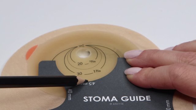 Colostomy bag, supply needed after colostomy surgery - colon cancer treatment. Ostomy bag in skin color. Medical theme. Stoma bag ready to use. Drawing hole for cutting opening with stoma guide.