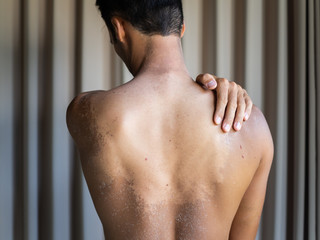 Fototapeta na wymiar Sunburned man stands with his back. Uneven tan. Skin care.. 