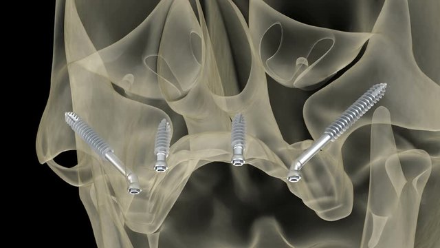 Maxillary prosthesis supported by zygomatic implants. Medically accurate 3D animation of human teeth and dentures