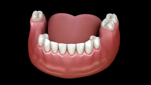 Removable partial denture, mandibular prosthesis. Medically accurate 3D animation of prosthodontics concept