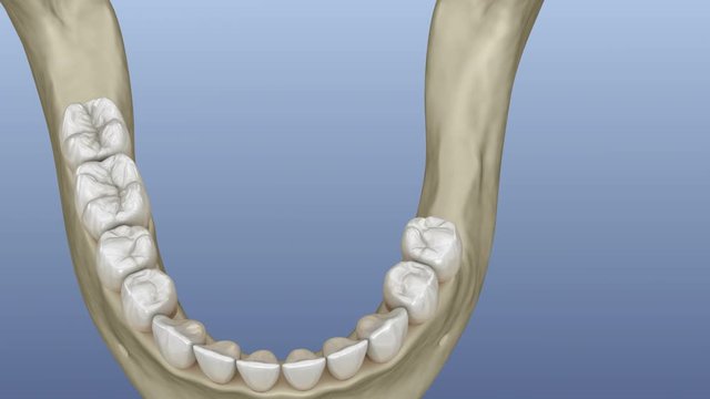 Implantation with mini implants in to recessed jaw bone: Medically accurate 3D animation