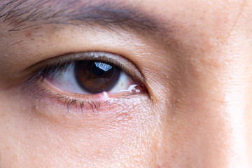 Close up of woman patient's infected eye. .Purulent eyes at right loer eyelid