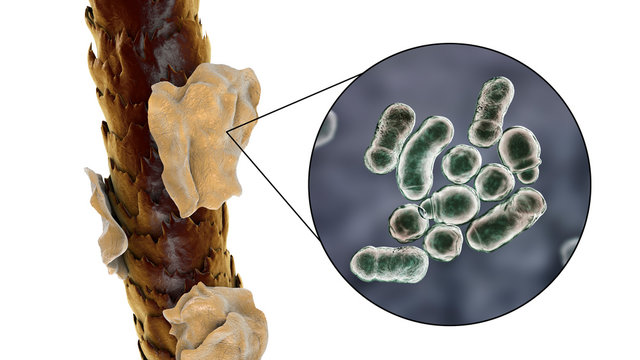 Human hair with dandruff and close-up view of microscopic fungi Malassezia furfur that cause dandruff and seborrhoeic dermatitis, 3D illustration