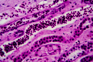 Fototapeta na wymiar Diffuse proliferative glomerulonephritis, DPGN, light micrograph, photo under microscope. High magnification