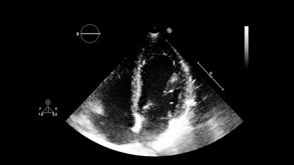 Image of the heart in gray-scale mode during transesophageal ultrasound.