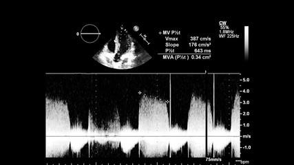 Image of the heart in gray-scale mode during transesophageal ultrasound.