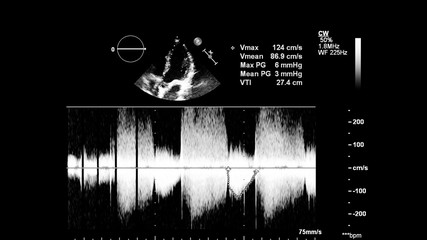 Image of the heart in gray-scale mode during transesophageal ultrasound.