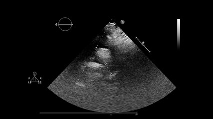 Image of the heart in gray-scale mode during transesophageal ultrasound.