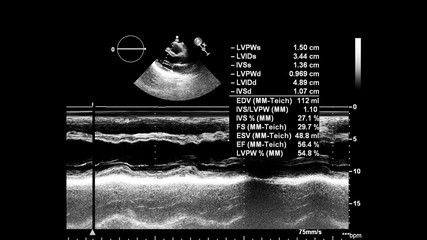 Image of the heart in gray-scale mode during transesophageal ultrasound.