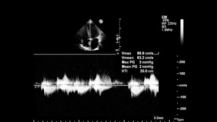 Image of the heart in gray-scale mode during transesophageal ultrasound.