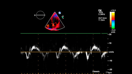 Image of the heart during transesophageal ultrasound with Doppler mode.
