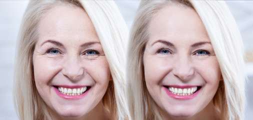 Middle age close up woman happy face before after cosmetic procedures. Skin care for wrinkled face....