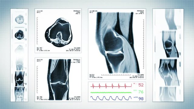 Knee MRI Scan. White. 4 videos in 1 file. Animation showing top, front, lateral view and ECG display. Each video is loopable. Medical Background. More options in my portfolio.