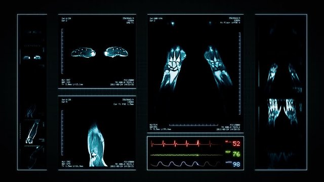 Arm MRI Scan. Blue. 3 videos in 1 file. Animation showing top, front, lateral view and ECG display. Each video is loopable. Medical Background. More options in my portfolio.