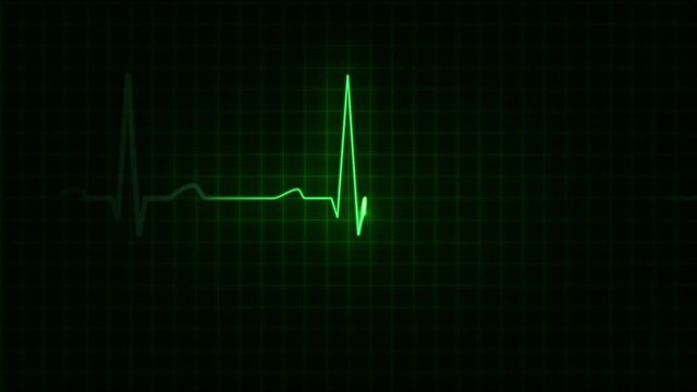  Electrocardiogram. Loopable. 3 in 1. Green. Heartbeat waves showing 3 conditions: tachycardia, healthy heartbeat and loose of heartbeat. 