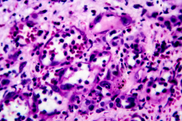 Histopathology of interstitial nephritis, light micrograph, photo under microscope. High magnification