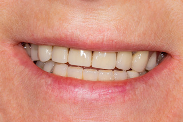 two chewing side teeth of the upper jaw after treatment of caries. Restoration of the chewing surface with a photopolymer filling material using the Rubber Dam system