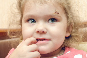 A little girl with a scar above her eyebrow, a deep wound sewn up