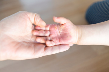 Burned hand of small child
