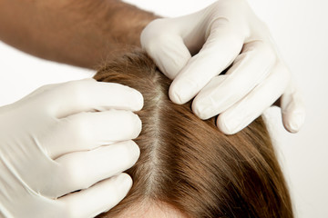 Doctor examining womans hair scalp, scalp eczema, dermatitis, psoriasis, hair loss, dandruff or dry scalp problem - obrazy, fototapety, plakaty