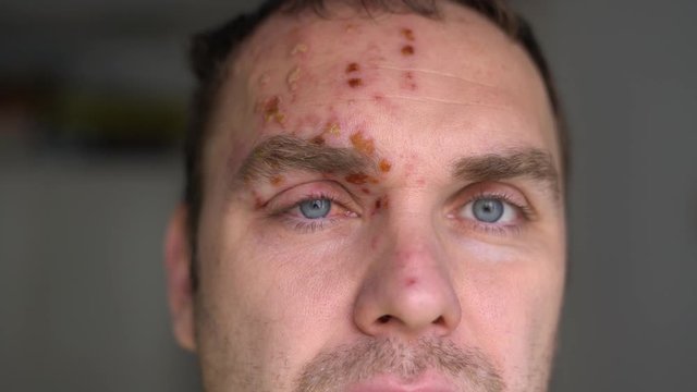 face of a man suffering from herpes zoster on the 7th day of illness. shingles.