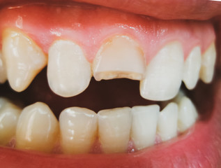 Broken tooth. Broken upper incisor in a man mouth.