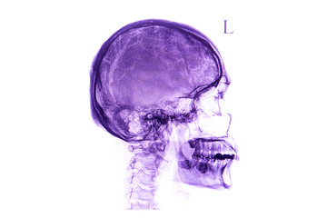Human skull xray