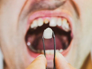 patient without a tooth is trying on a denture